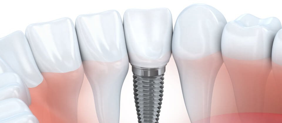 visual-vector-illustration-of-dental-implant